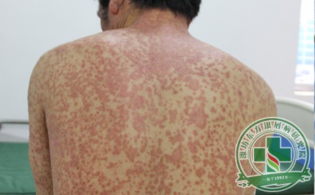 可以幾年的銀屑病怎么治療好