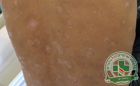 土辦法和洋方案哪種方法治療銀屑病靠譜?