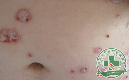 治療銀屑病不宜局限思維 臨床治療更加重要