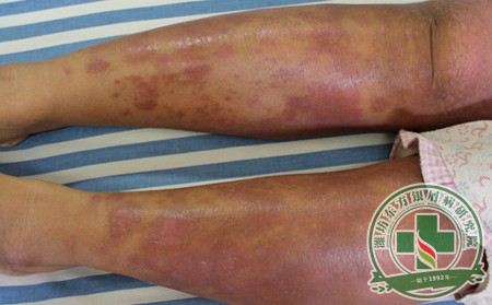 鞏固治療不可少 剖析銀屑病治療中的至關重要一環