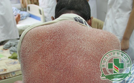 完整流程是患者治好的基礎(chǔ) 銀屑病治療三部曲