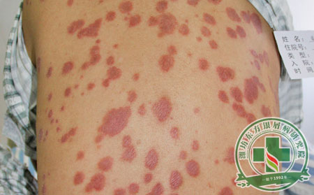 秋冬季節尋常型銀屑病面臨轉型危機 是時候注意了