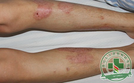 治療銀屑病您會遇到哪些問題?山東銀屑病醫院解答