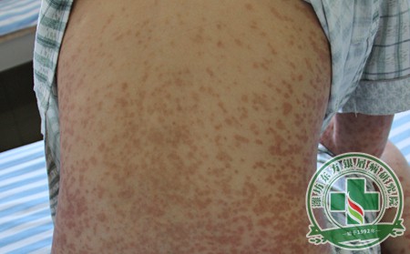 怎樣做好延長山東尋常型銀屑病復發的周期?