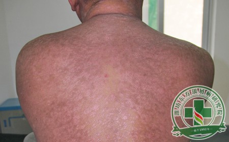 夏季不治冬季難熬 祛“屑”不能求一時