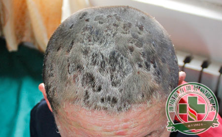 銀屑病熱搜榜 頭皮型銀屑病的中西醫(yī)治療PK