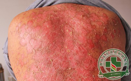 濰坊銀屑病去哪里治呢