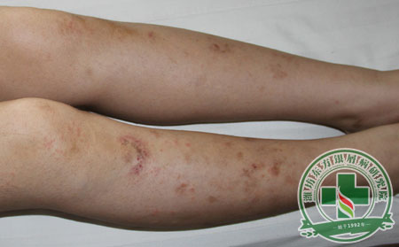 小雪期間 銀屑病患者怎樣抵抗感冒侵襲?