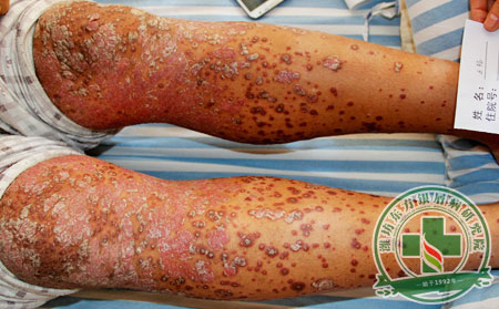 牛皮癬治療醫院