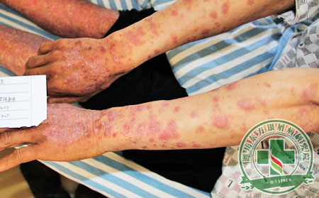 為什么濰坊銀屑病冬季容易復(fù)發(fā)或加重?