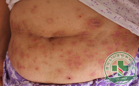 在濰坊治銀屑病的價格高不高