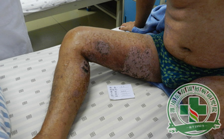 銀屑病怎么發生的呢