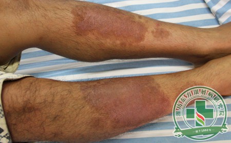 如何正確護理銀屑病患者