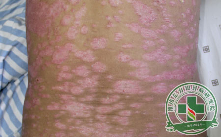 尋常型銀屑病癥狀圖片有哪些表現