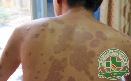 內分泌誘發銀屑病產生