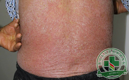 銀屑病能不能好的?去哪里好的