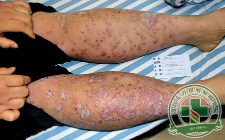 銀屑病治療醫生