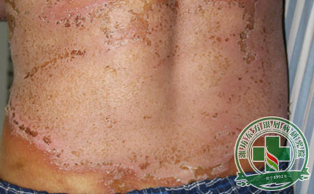 怎么能順利的好的銀屑病?