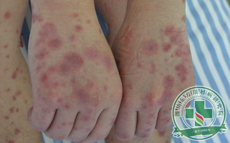 銀屑病非常好的治療方法是什么