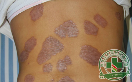 銀屑病治療后皮膚變黑怎么護理?