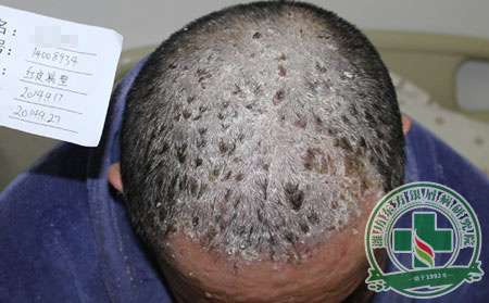 銀屑病治療會(huì)不會(huì)復(fù)發(fā)