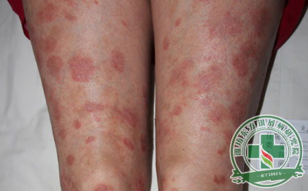 濰坊銀屑病醫院還您健康肌膚