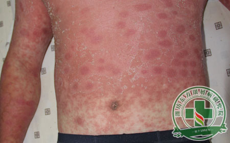 銀屑病到底怎么治才能好的?