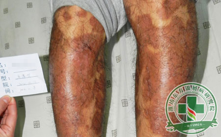 怎么防止冬季銀屑病復發