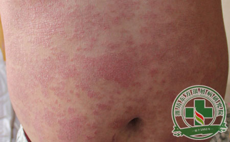 哪些錯誤的銀屑病治療方式導致銀屑病反復發作