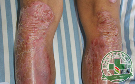 濰坊銀屑病患者冬天預防復發的方法