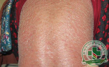 有沒有避免復發的銀屑病治療方法