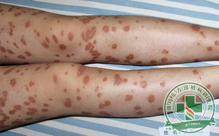 寒假治療銀屑病時間夠不夠