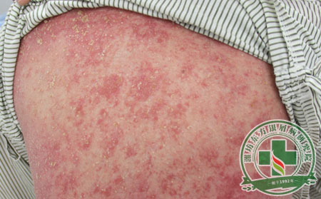 2016新的一年治療銀屑病要注意什么