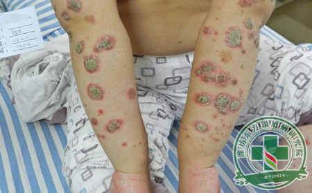 治療銀屑病時患者怎么想