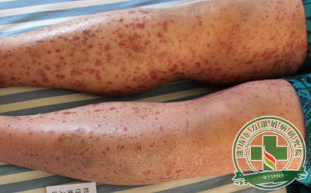 銀屑病能不能去根?怎么去根?