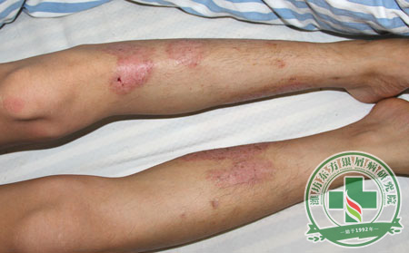 膿皰型銀屑病是什么