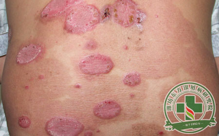 到底怎么才能好的頑固的銀屑病啊