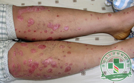 銀屑病的復發問題怎么解決?