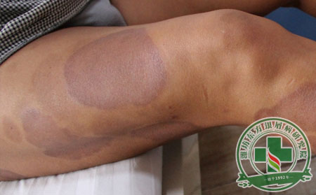 大腿斑塊狀銀屑病怎么治療能消退