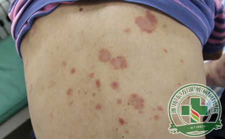 濰坊銀屑病醫院對初次就診的患者如何治療