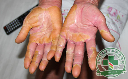 如何減少關節型牛皮癬對患者的傷害