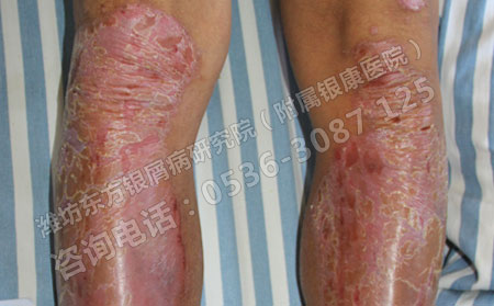 膿皰型銀屑病有什么表現