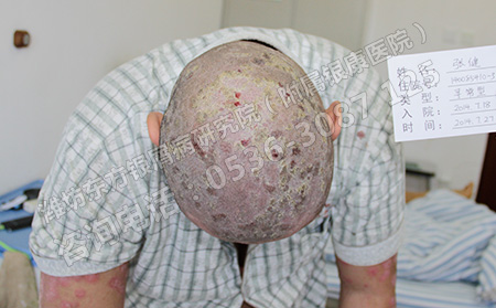 頭皮型銀屑病快速治好的方法