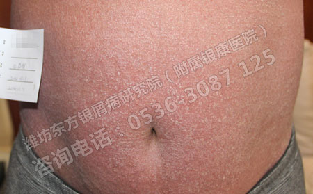 得了銀屑病的紅皮病該怎么治