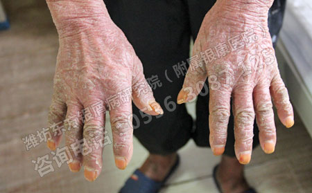 寒流來襲銀屑病患者警惕病情蠢蠢欲動