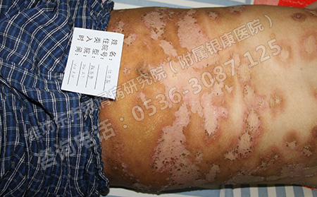 銀屑病患者的冬季養(yǎng)生之道