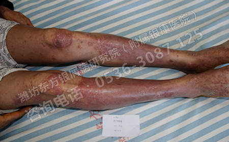 銀霄病怎樣才能有效好的呢