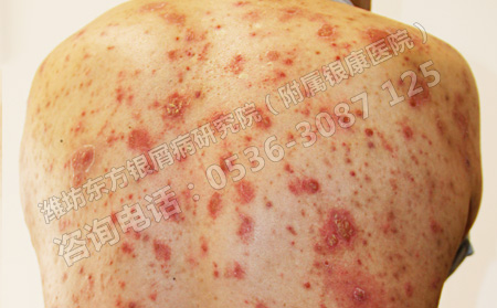 銀屑病臨床表現只有鱗屑與薄膜嗎