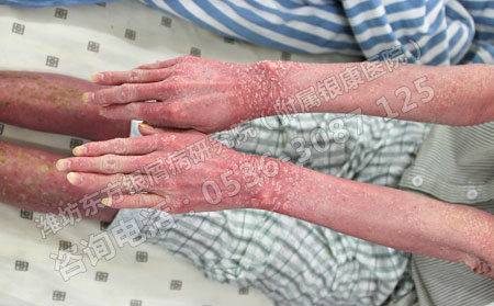 掌跖膿皰病能快速消除小膿皰嗎