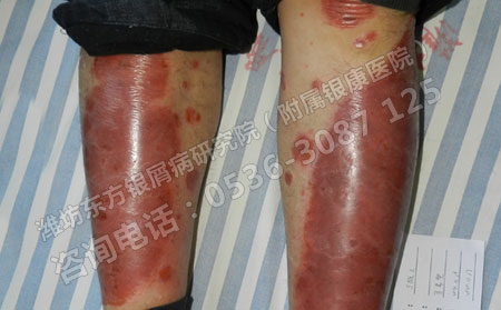 紅皮型銀屑病有什么明顯的病情特征